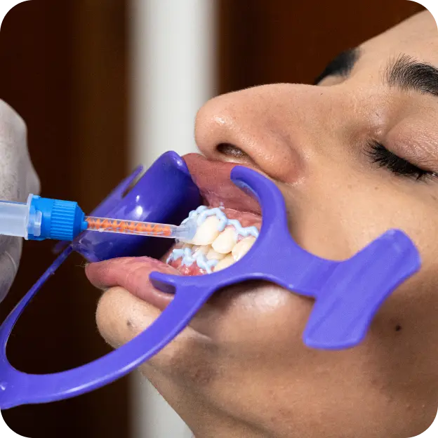 Whitening Procedure